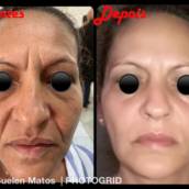 Harmonização Facial em Bauru