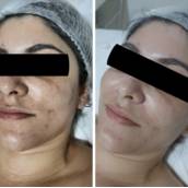 Limpeza de Pele e Peeling em Avaré – Renovação e Vitalidade