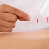 Acupuntura
