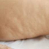 Massagem para Lipedema
