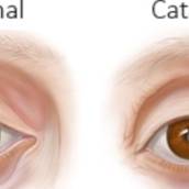 Cirurgia de catarata