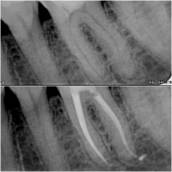 O tratamento endodôntico, popularmente conhecido como 