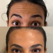 Toxina botulínica (botox)