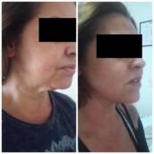 Tratamento para Papada em Avaré – Rosto Definido e Rejuvenescido