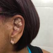 Auriculoterapia