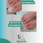 Podologia em Santa Helena de Goiás – Saúde e Conforto para Seus Pés