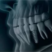 Guia Cirúrgico para Implantes