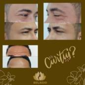 BOTOX (Toxina Botulinica)