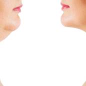 Lipo de papada em Resende, RJ por Clínica Torquato