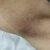 Depilação de Axilas Masculina