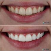 O Clareamento dental é um dos tratamentos estéticos mais procurados porque transforma muito mais do que o sorriso: ele eleva a autoestima e a confiança. Realizado de forma segura, com acompanhamento profissional, proporciona dentes naturalmente mais claros sem comprometer a saúde da estrutura dental.
O clareamento revela um sorriso mais radiante em pouco tempo. É a união perfeita entre estética e saúde, proporcionando dentes claros, brilho natural e a sensação imediata de renovação.