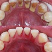Raspagem Periodontal 