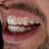 Os Alinhadores Ortodônticos representam a Ortodontia moderna: discreta, confortável e altamente previsível. Desenvolvidos por meio de tecnologia digital, cada etapa do tratamento é cuidadosamente planejada, permitindo ao paciente visualizar o resultado antes mesmo de iniciar o uso.
Translúcidos e removíveis, oferecem liberdade para comer, escovar os dentes e viver o dia a dia sem limitações, ao mesmo tempo em que promovem movimentações dentárias precisas e eficazes. Uma forma inovadora de alinhar o sorriso, unindo estética, praticidade e ciência. 