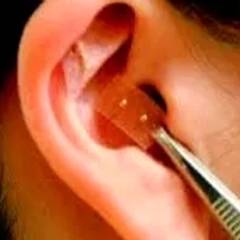 Acupuntura auricular em Bauru