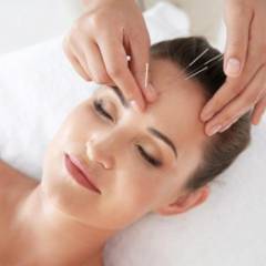 Acupuntura Estética