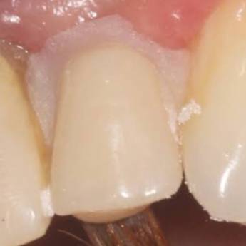 Comprar o produto de Dente Provisorio (dente de estoque)  em A Classificar em Bauru, SP por Solutudo