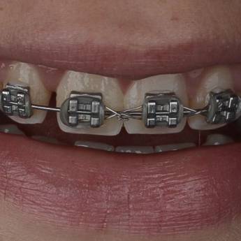 Comprar o produto de Ortodontia em Francisco Beltrão – Correção Precisa e Sorrisos Saudáveis em Odontologia em Francisco Beltrão, PR por Solutudo Comprar o produto de Ortodontia em Francisco Beltrão – Correção Precisa e Sorrisos Saudáveis em Odontologia em Francisco Beltrão, PR por Solutudo