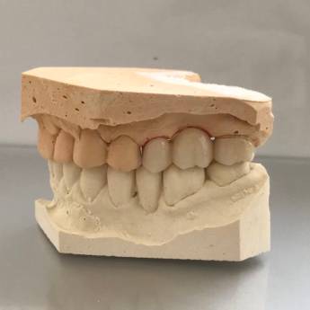 Comprar o produto de Prótese Fixa (“coroa de porcelana ou jaqueta”) em A Classificar em Bauru, SP por Solutudo