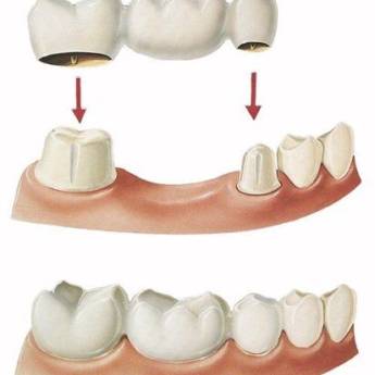 Comprar o produto de Prótese Fixa (“coroa de porcelana ou jaqueta”) em A Classificar em Bauru, SP por Solutudo