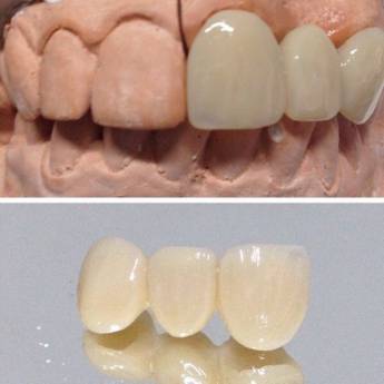 Comprar o produto de Prótese Fixa (“coroa de porcelana ou jaqueta”) em A Classificar em Bauru, SP por Solutudo