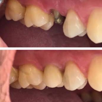 Comprar o produto de Prótese Fixa (“coroa de porcelana ou jaqueta”) em A Classificar em Bauru, SP por Solutudo