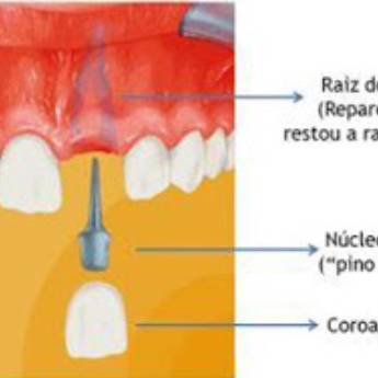 Comprar o produto de Pivô em Odontologia em Bauru, SP por Solutudo