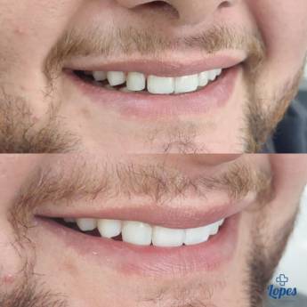 Comprar o produto de Restauração e Preenchimento com Resina em Bauru em Odontologia em Bauru, SP por Solutudo