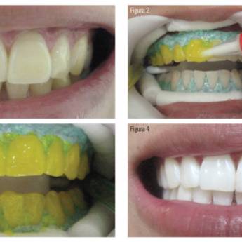 Comprar o produto de Clareamento em Consultório em Odontologia em Bauru, SP por Solutudo