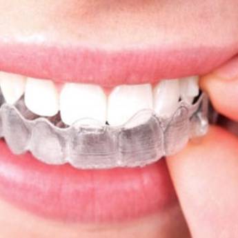 Comprar o produto de Clareamento Caseiro em Odontologia em Bauru, SP por Solutudo