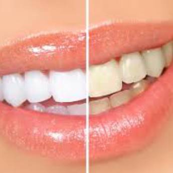 Comprar o produto de Clareamento  em Outros Serviços em Botucatu, SP por Solutudo