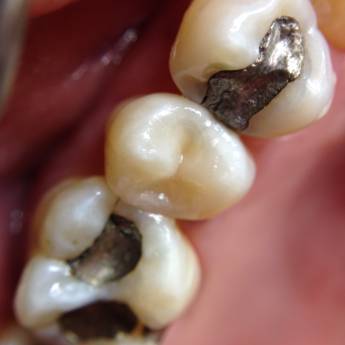 Comprar o produto de Restauração em Resina Composta em Odontologia em Jundiaí, SP por Solutudo