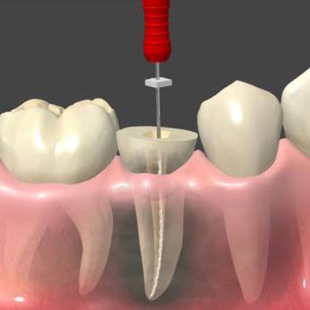 Comprar o produto de Endodontia (Tratamento de Canal) em Odontologia em Botucatu, SP por Solutudo