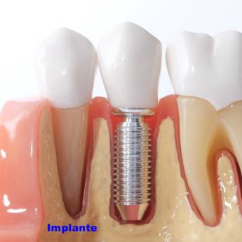 Comprar o produto de Cirurgia Implante em Odontologia em Botucatu, SP por Solutudo