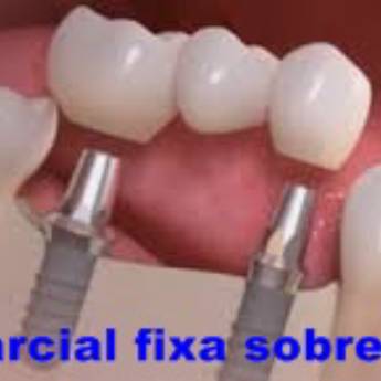 Comprar o produto de Cirurgia Implante em Odontologia em Botucatu, SP por Solutudo