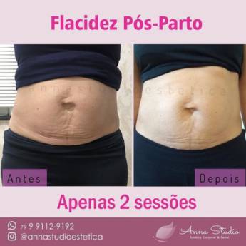 Comprar o produto de Flacidez pós parto em Estética Corporal em Aracaju, SE por Solutudo