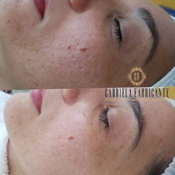 Comprar o produto de Radiofrequência Fracionada em Clínicas de Estética e Beleza em Bauru, SP por Solutudo