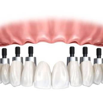 Comprar o produto de Implantes Dentários em Odontologia em Assis, SP por Solutudo