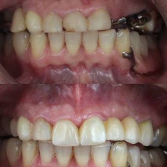 Comprar o produto de Prótese Protocolo em Odontologia em Assis, SP por Solutudo