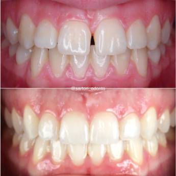 Comprar o produto de Clareamento  em Odontologia em Assis, SP por Solutudo