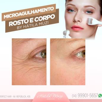 Comprar o produto de Microagulhamento - Rosto e Corpo em Beleza e Cuidado Pessoal em Marília, SP por Solutudo