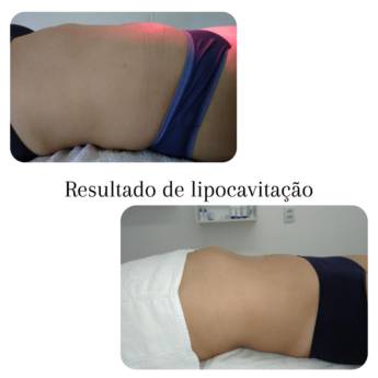 Comprar o produto de Lipocavitação  em Beleza e Cuidado Pessoal em Marília, SP por Solutudo