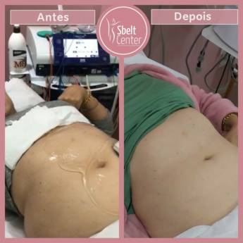Comprar o produto de Criolipólise - Antes e Depois em Beleza e Cuidado Pessoal em Bauru, SP por Solutudo