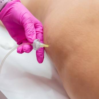 Comprar o produto de Criolipólise em Beleza e Cuidado Pessoal em Bauru, SP por Solutudo