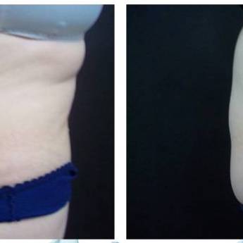 Comprar o produto de Criofrequência em Avaré em Clínicas de Estética e Beleza em Avaré, SP por Solutudo