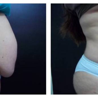 Comprar o produto de Criofrequência em Avaré em Clínicas de Estética e Beleza em Avaré, SP por Solutudo