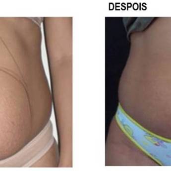 Comprar o produto de Criofrequência  + Ultracavitação em Avaré em Clínicas de Estética e Beleza em Avaré, SP por Solutudo