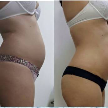 Comprar o produto de Criofrequência e Cavitação em Avaré em Clínicas de Estética e Beleza em Avaré, SP por Solutudo