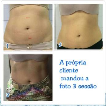 Comprar o produto de  Criofrequência e Cavitação em Avaré em Clínicas de Estética e Beleza em Avaré, SP por Solutudo
