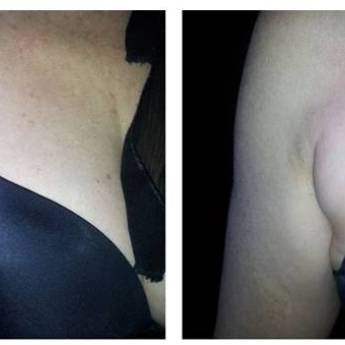 Comprar o produto de  Criofrequência - Braço em Avaré em Clínicas de Estética e Beleza em Avaré, SP por Solutudo