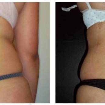 Comprar o produto de Criofrequência e Cavitação em Avaré em Clínicas de Estética e Beleza em Avaré, SP por Solutudo